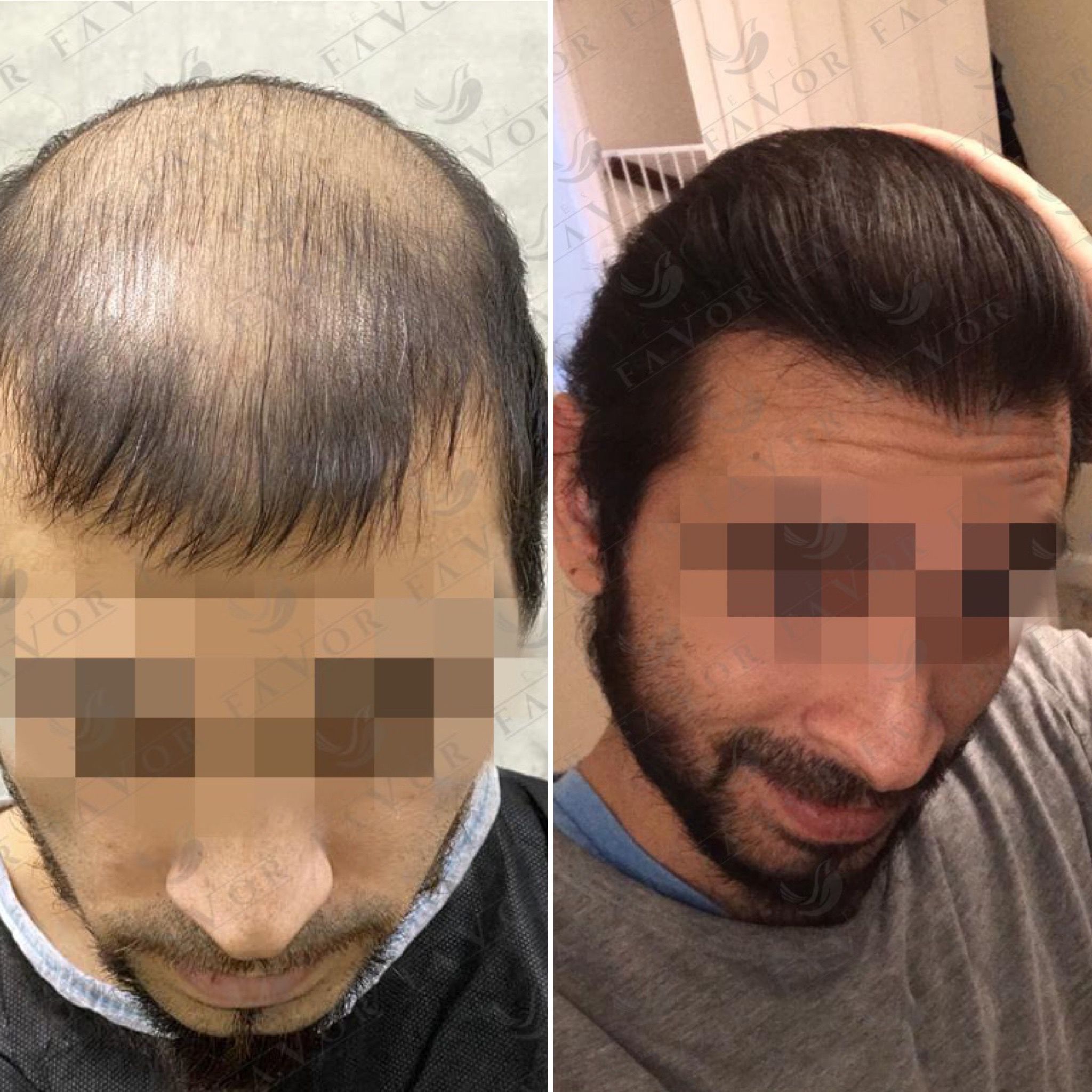 top hair transplant clinics in usa