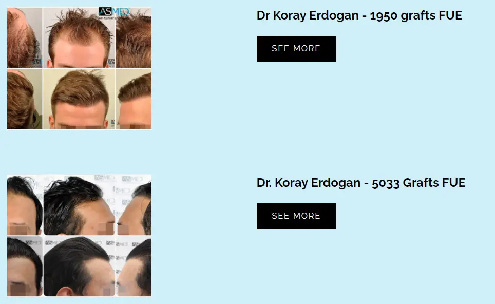 Før efter hårtransplantation hos Asmed Turkey